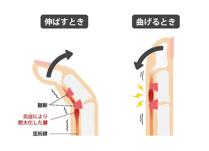 指の使いすぎ