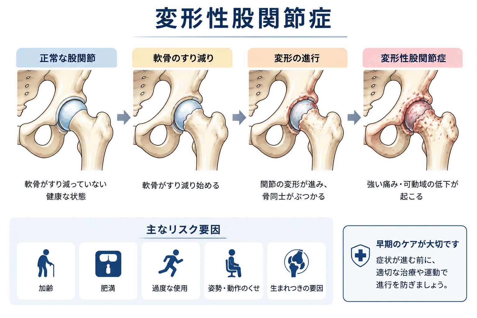 変形性股関節症